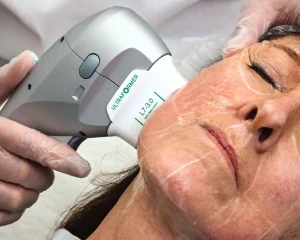 هایفوتراپی در رازلیزر