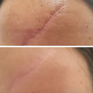 از بین بردن جای بخیه با بهترین لیزر رازلیزر
