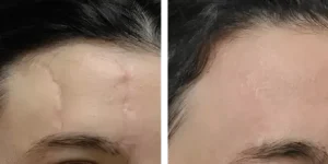 بهترین مرکز حذف جای بخیه کلینیک رازلیزر
