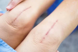 رازلیزر از بین بردن جای بخیه