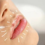 راز لب‌های پر و طبیعی با ژل؛ چرا همه به تزریق ژل لب اعتماد می‌کنند؟