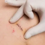 جلوگیری از ماندن جای بخیه | راهکارهای قطعی و لیزر تخصصی در کلینیک رازلیزر
