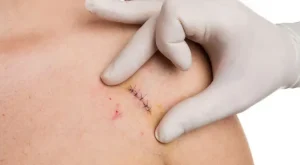 لیزر جای بخیه در کلینیک رازلیزر