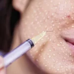 مزوتراپی پوست در مقابل لیزر فرکشنال؛ کدام درمان ماندگارتر است؟