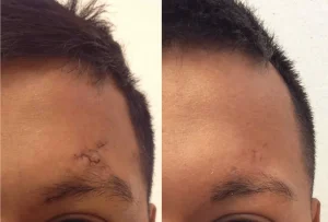 حذف جای بخیه در کلینیک رازلیزر