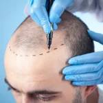جدیدترین روش کاشت مو ۱۴۰۴؛ نگاهی به فناوری‌های روز دنیا در رازلیزر