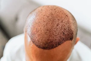 کاشت مو در کلینیک رازلیزر
