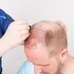 کاشت مو با تکنولوژی جدید؛ خداحافظی با طاسی و ظاهر مصنوعی