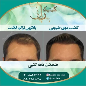 کاشت مو در کلینیک رازلیزر