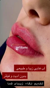 کلینیک رازلیزر تزریق ژل لب
