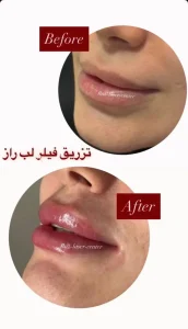 تزریق ژل لب در کلینیک رازلیزر