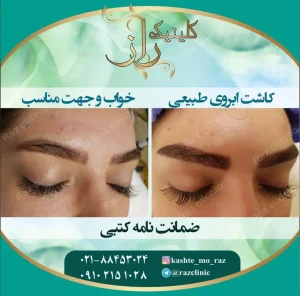 کاشت ابرو در کلینیک رازلیزر