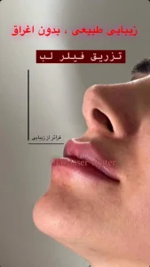تزریق فیلر لب در رازلیزر