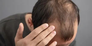 کاشت مو مدرن در کلینیک رازلیزر