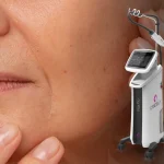 لیزر فرکس پرو کندلا: جوان‌سازی پوست و رفع جای جوش با تکنولوژی پیشرفته