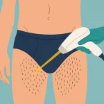 چند جلسه لیزر بیکینی آقایان لازم است؟ | راهنمای جامع و واقعی