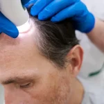اشتباهات رایج در انتخاب روش کاشت مو مدرن | تکنولوژی جدید کاشت مو
