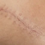 رفع جای زخم و بخیه با لیزر | درمان قطعی اسکار پوستی در رازلیزر