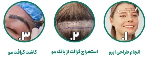 کاشت ابرو و مو در کلینیک رازلیزر