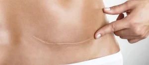 رفع جای بخیه با لیزر