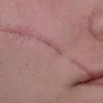 بهترین روش رفع جای زخم و بخیه چیست؟ | لیزر یا درمان‌های دیگر؟