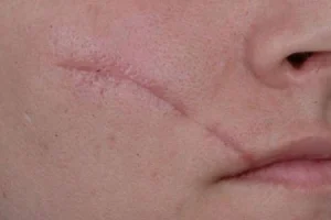 انواع جای زخم و بخیه در کلینیک رازلیزر