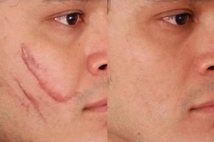 درمان انواع جای زخم و بخیه در کلینیک رازلیزر