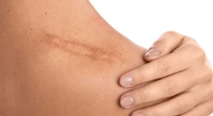 کلینیک رازلیزر انواع جای زخم