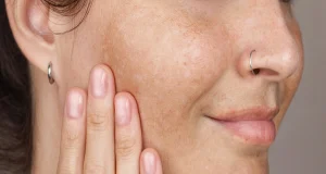 رفع لک صورت در کلینیک رازلیزر
