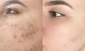 رفع جای اسکار در رازلیزر