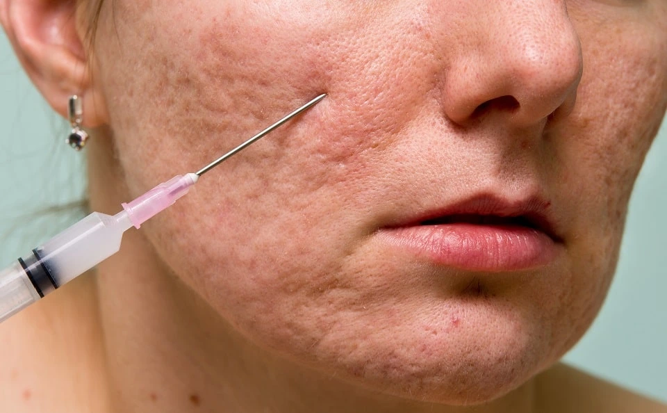 رفع جای اسکار در کلینیک رازلیزر