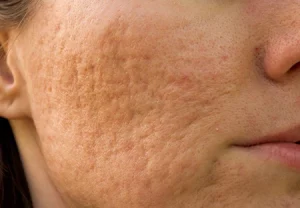 کلینیک رازلیزر رفع جای اسکار
