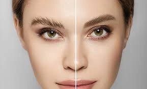 کاشت ابرو در کلینیک رازلیزر