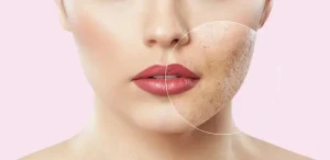 رفع جای اسکار در رازلیزر