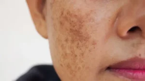 رفع لک صورت در کلینیک رازلیزر