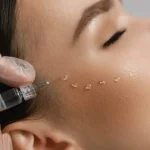 آیا مزوتراپی واقعاً برای ریزش مو و جوانسازی پوست مؤثر است؟