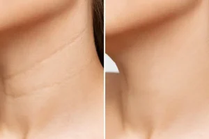 کلینیک رازلیزر جوانسازی گردن
