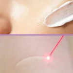 لیزر بهتر است یا کرم‌های ترمیم‌کننده؟ بهترین راه رفع جای زخم چیست؟