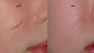 رفع جای بخیه در کلینیک رازلیزر