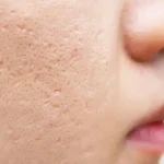 رفع جای اسکار بدون جراحی؛ واقعیت یا تبلیغات؟