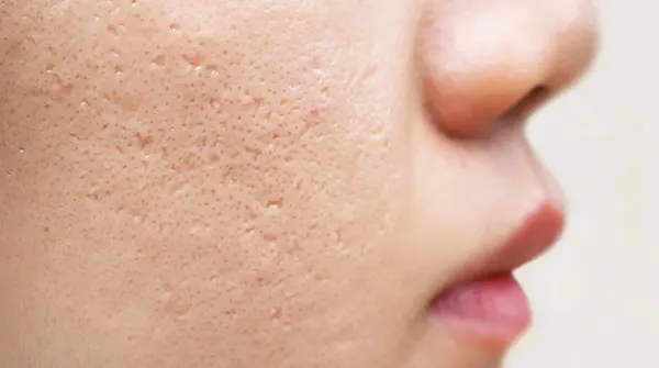 رفع جای اسکار با لیزر در کلینیک رازلیزر