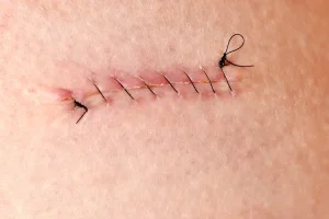 رفع جای بخیه در کلینیک رازلیزر