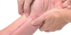 رفع جای زخم در کلینیک رازلیزر