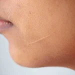 چرا با وجود استفاده از کرم ترمیم‌ کننده، جای زخم من از بین نمی‌ رود؟
