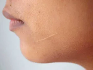 رفع جای زخم قدیمی در کلینیک رازلیزر