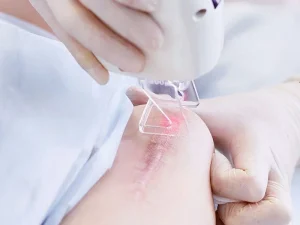 کلینیک رازلیزر از بین بردن جای بخیه