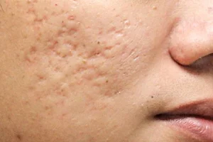 کلینیک رازلیزر رفع جای اسکار با لیزر