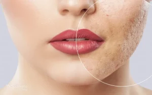 کلینیک رازلیزر رفع جای اسکار
