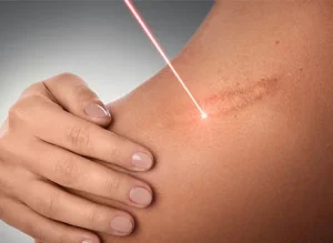 کلینیک رازلیزر رفع جای زخم 