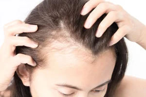 ریزش مو بعد از استرس کلینیک رازلیزر